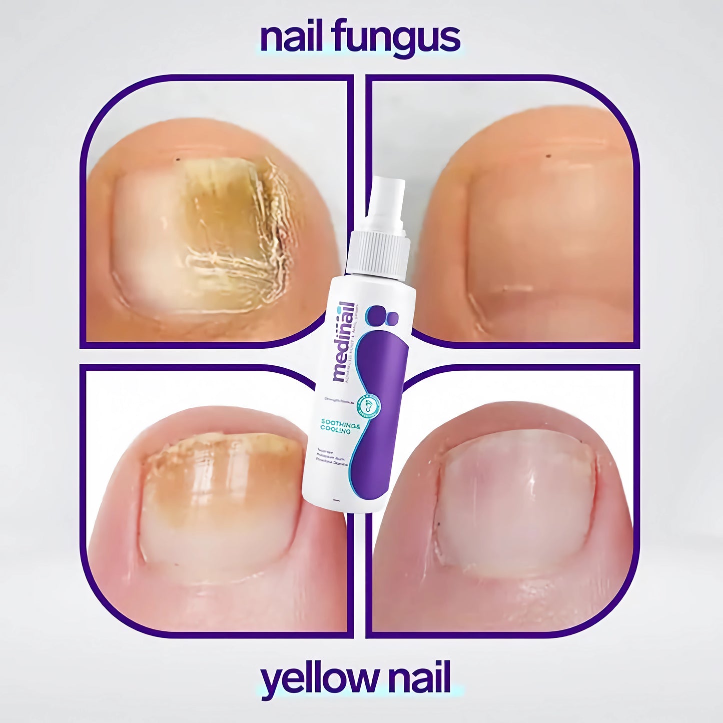 Jaysuin - Nail Fungus Spray